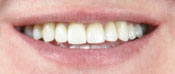 Teeth After Using Veeners